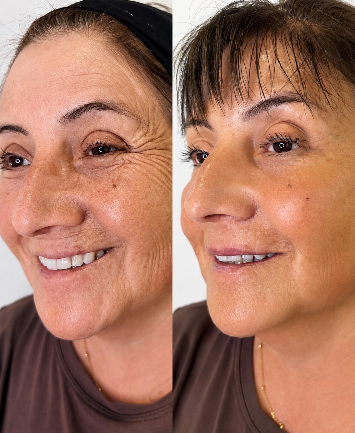 Armonización facial