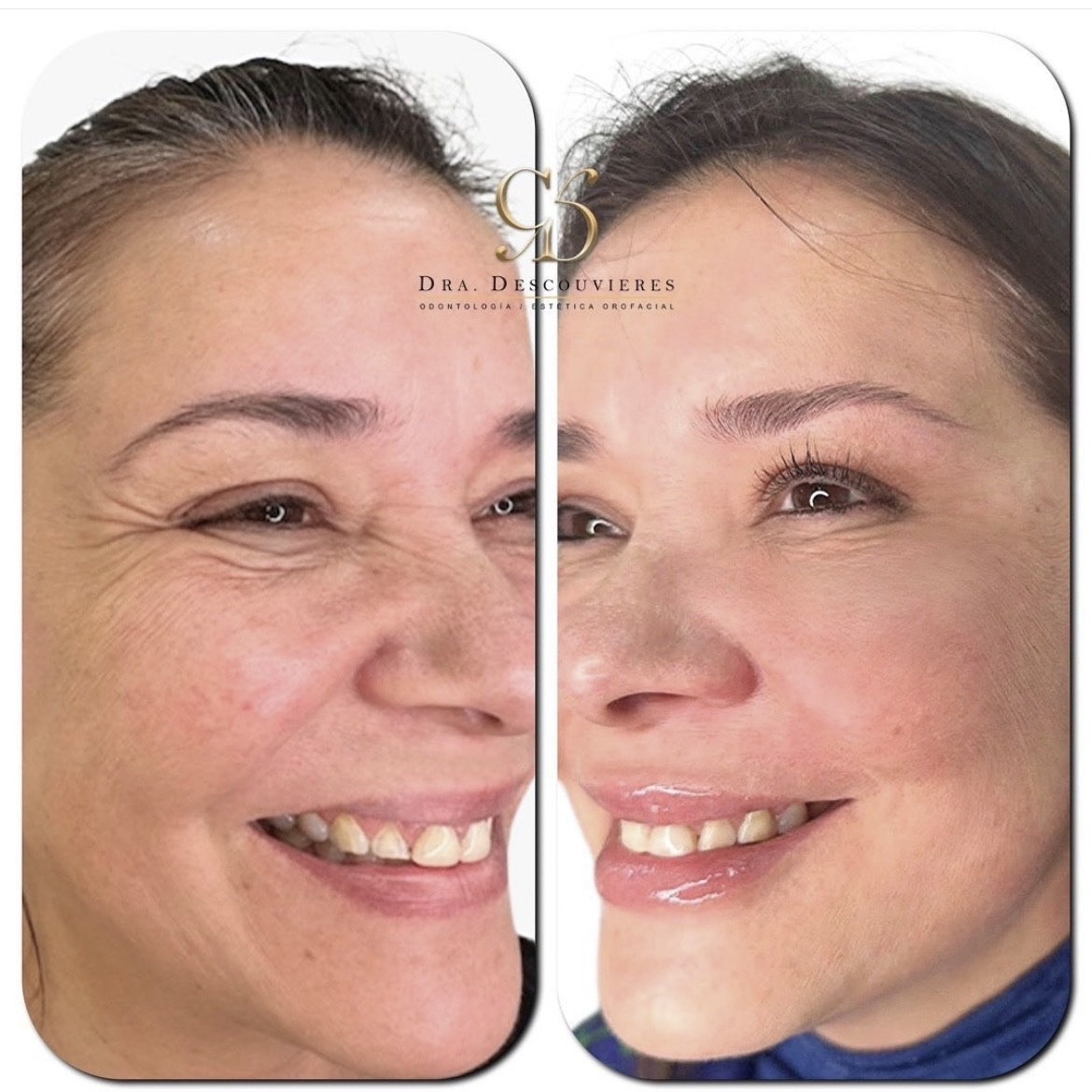 Rejuvenecimiento facial